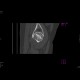 Aseptic necrosis of the femoral head: CT - Computed tomography