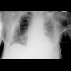 bronchial carcinoma, central, pneumonitis: X-ray - Plain radiograph
