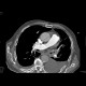 bronchial carcinoma, central, pneumonitis: CT - Computed tomography