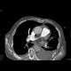 bronchial carcinoma, central, pneumonitis: CT - Computed tomography