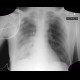 Bronchopneumonia: X-ray - Plain radiograph