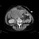 Ovarial carcinoma, peritoneal carcinomatosis: CT - Computed tomography