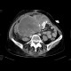 Ovarial carcinoma, peritoneal carcinomatosis: CT - Computed tomography