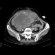 Ovarial carcinoma, peritoneal carcinomatosis: CT - Computed tomography