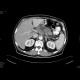 Carcinoma of pancreas: CT - Computed tomography