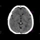 Cavum septi pellucidi: CT - Computed tomography