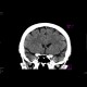 Cavum septi pellucidi: CT - Computed tomography