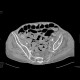 Small bowel ischemia, mesenterial thrombosis: CT - Computed tomography