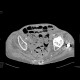 Small bowel ischemia, mesenterial thrombosis: CT - Computed tomography