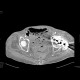 Small bowel ischemia, mesenterial thrombosis: CT - Computed tomography