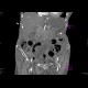 Small bowel ischemia, mesenterial thrombosis: CT - Computed tomography