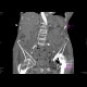 Small bowel ischemia, mesenterial thrombosis: CT - Computed tomography