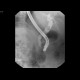 Choledocholithiasis, bile duct stones, ERCP: RF - Fluoroscopy