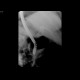 Choledocholithiasis, bile duct stones, ERCP: RF - Fluoroscopy