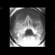 Chronic sinusitis, foreign body: X-ray - Plain radiograph