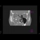 Chronic sinusitis, foreign body: CT - Computed tomography