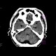 Cisterna cerebellomedullaris permagna: CT - Computed tomography