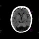 Cisterna cerebellomedullaris permagna: CT - Computed tomography