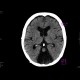 Cisterna cerebellomedullaris permagna: CT - Computed tomography