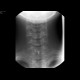 Foreign body in the oesophagus: RF - Fluoroscopy