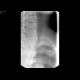 Foreign body in the oesophagus: RF - Fluoroscopy
