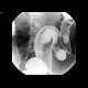 Crohn's disease, colitis: RF - Fluoroscopy