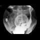 Crohn's disease, colitis: RF - Fluoroscopy