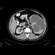 Splenic cysts, congenital, epithelial: CT - Computed tomography