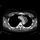 Dissecting aneurysm of the thoracic aorta: CT - Computed tomography