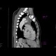 Dissecting aneurysm of the thoracic aorta: CT - Computed tomography