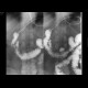 Duodenal diverticulum, large and multiple: RF - Fluoroscopy