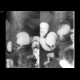 Duodenal diverticulum, large and multiple: RF - Fluoroscopy