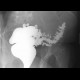 Diverticulosis of the colon: RF - Fluoroscopy