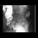 Diverticulosis of the colon: RF - Fluoroscopy