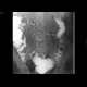 Diverticulosis of the colon: RF - Fluoroscopy