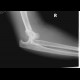 Elbow dislocation: X-ray - Plain radiograph
