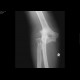 Elbow dislocation: X-ray - Plain radiograph