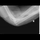 Elbow dislocation, after reposition: X-ray - Plain radiograph