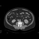 Renal tumour, small: CT - Computed tomography