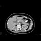 Edematous pancreatitis: CT - Computed tomography
