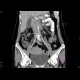 Edematous pancreatitis: CT - Computed tomography