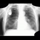 Panlobular emphysema, vanishing lung syndrome, bullous emphysema: X-ray - Plain radiograph