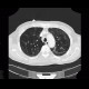 Panlobular emphysema, vanishing lung syndrome, bullous emphysema: CT - Computed tomography