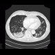 Panlobular emphysema, vanishing lung syndrome, bullous emphysema: CT - Computed tomography