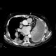 Empyema of the thorax: CT - Computed tomography