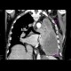 Empyema of the thorax: CT - Computed tomography