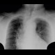 Deviation of trachea: X-ray - Plain radiograph