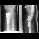 Fracture of the distal radius, fracture of compression plate: X-ray - Plain radiograph