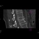 Compression fracture of lumbar vertebra: CT - Computed tomography