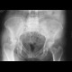 Acetabular fracture, posterior dislocation of the femoral head, dashboad injury: X-ray - Plain radiograph